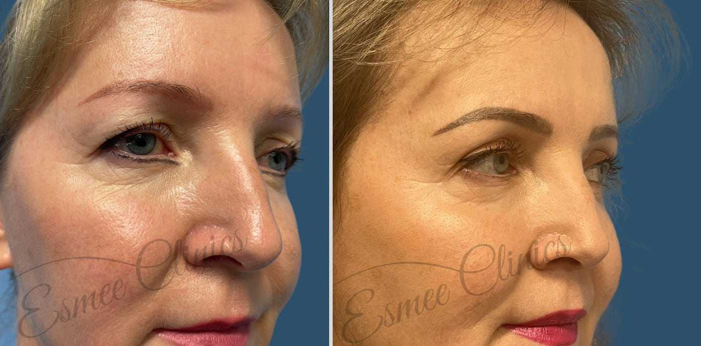 Before and After img